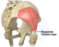 Endoscopic Hip Tendon Repair: Gluteus Medius & Hamstrings