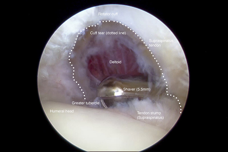 Shoulder Arthroscopy: Restoring Function and Flexibility