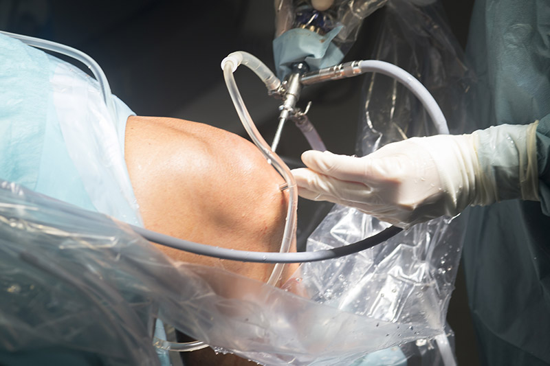 Knee Arthroscopy: The Road to Recovery